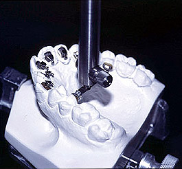 Colocar brackets